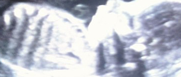 Leia mais sobre o artigo Rosto misterioso em ultrassonografia